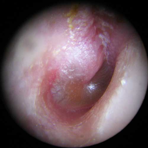 acute otitis media
