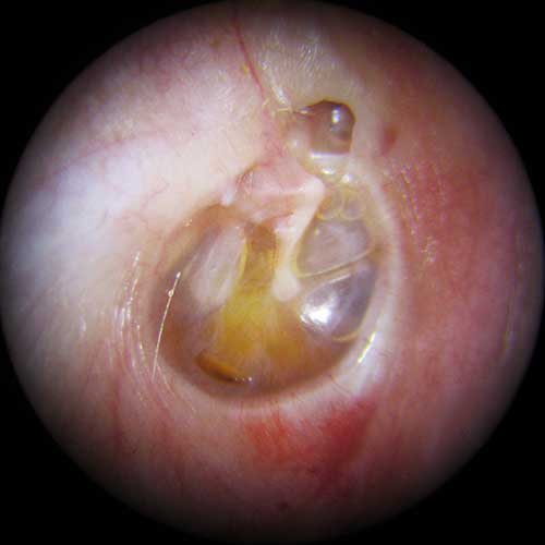 otitis media with effusio